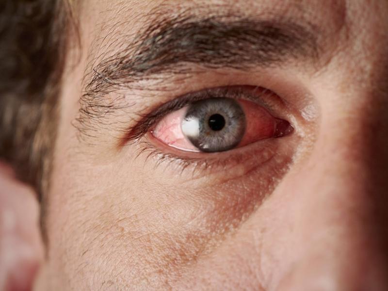 Κουρασμένα μάτια; 5 αιτίες και πώς να τις αντιμετωπίσετε