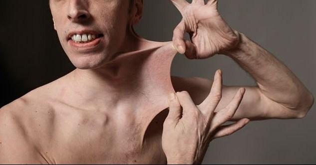 eds_skin_hyperextensibility_2.jpg Σύνδρομο Ehlers-Danlos