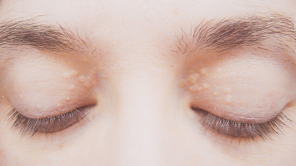 matia_xanthelasma