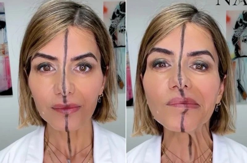 botox.jpg μποτοξ