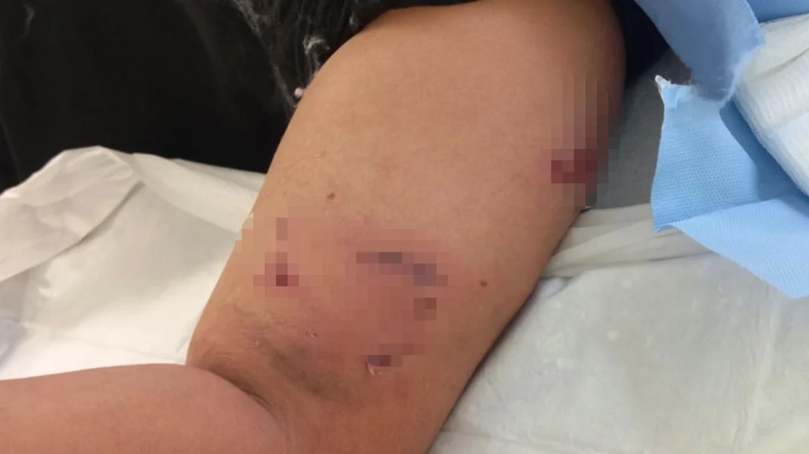 epithesi-skulou.jpg Τραύματα στο χέρι παιδιού από επίθεση σκύλου