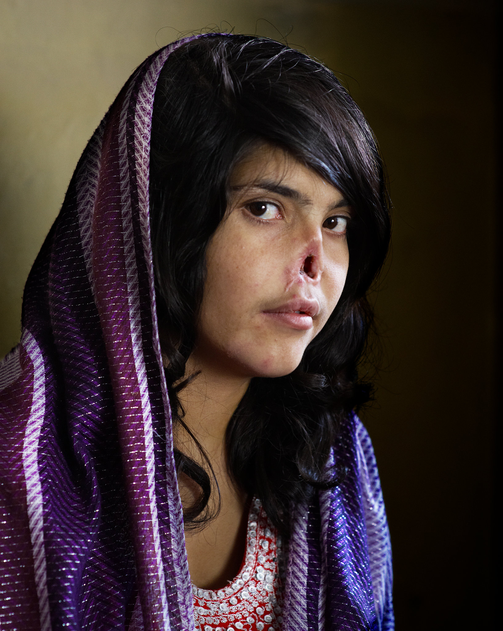 kampoyl_afganistan.jpg Bibi Aisha 18χρονη Αφγανή