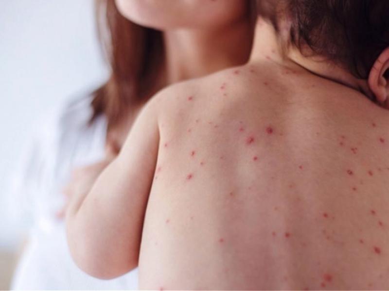 Κρούσματα ιλαράς: Ποιοι θα πρέπει να εμβολιαστούν 
