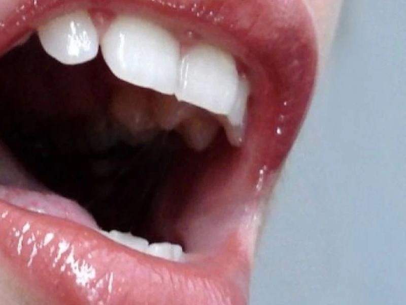 Καρκίνος: Πώς να ελέγξετε το στόμα σας – Τα 6 σημάδια που πρέπει να προσέξετε