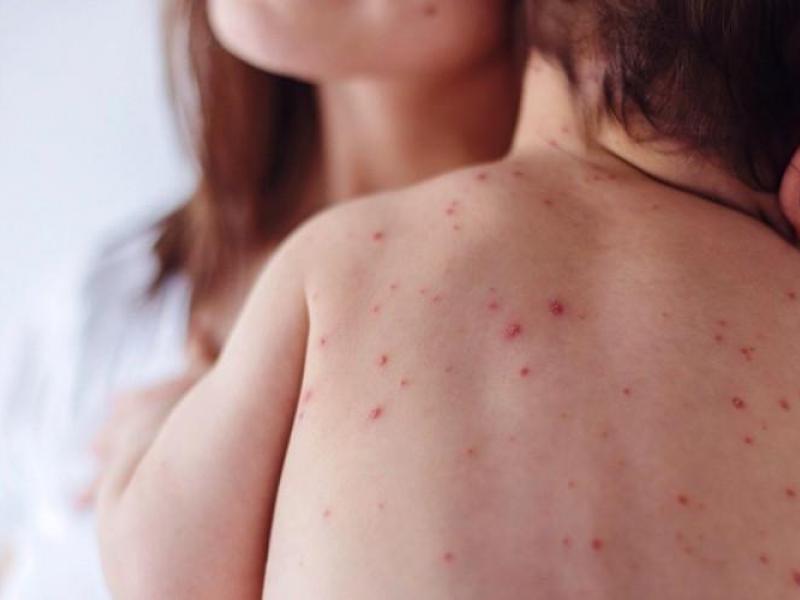 Ρουμανία: Επιδημία ιλαράς – Ανεμβολίαστα παιδιά οι περισσότεροι ασθενείς
