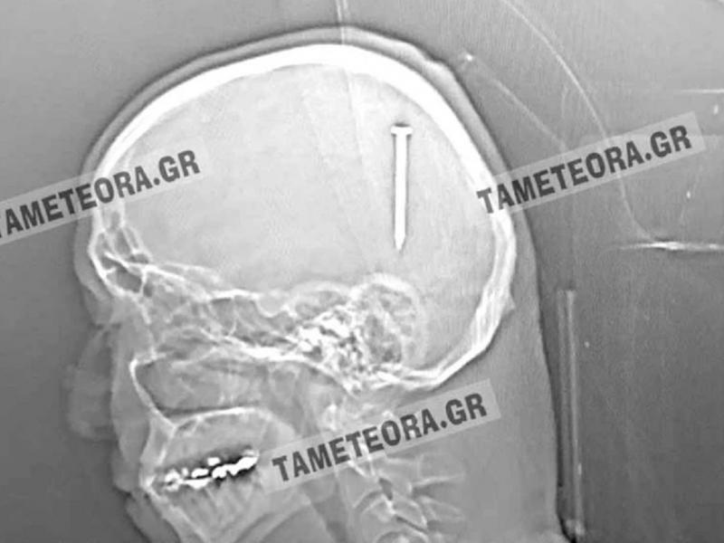 Απίστευτο περιστατικό στην Καλαμπάκα: Καρφί 5 εκατοστών σφηνώθηκε στο κεφάλι άνδρα
