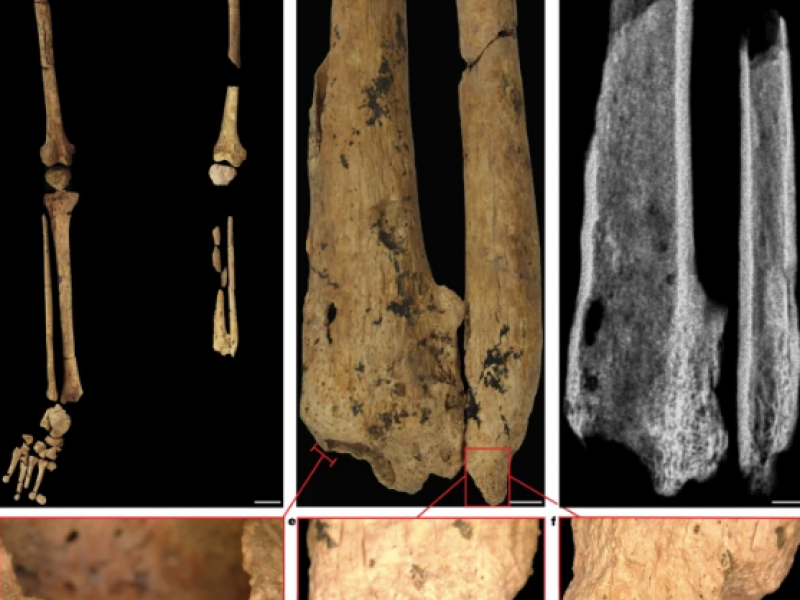 Βόρνεο: Ανακαλύφθηκε η αρχαιότερη ένδειξη χειρουργικής πριν 31.000 χρόνια