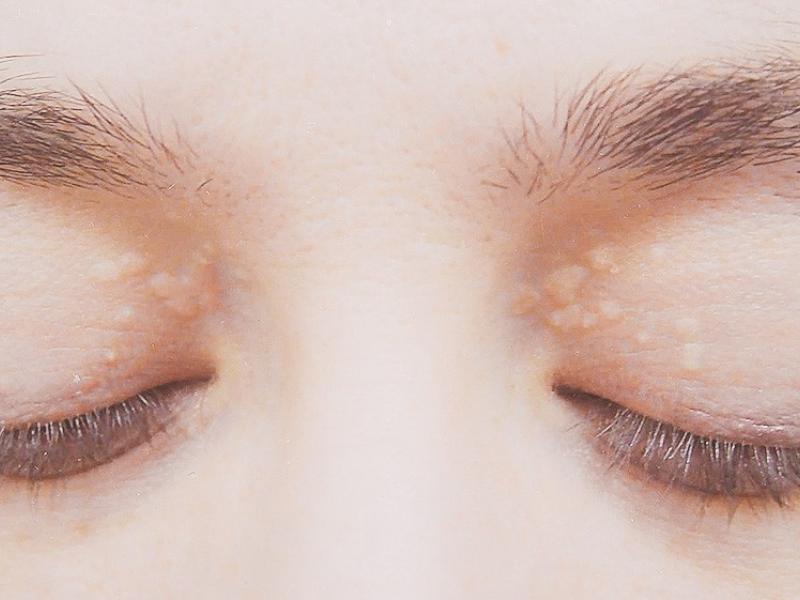 matia_xanthelasma