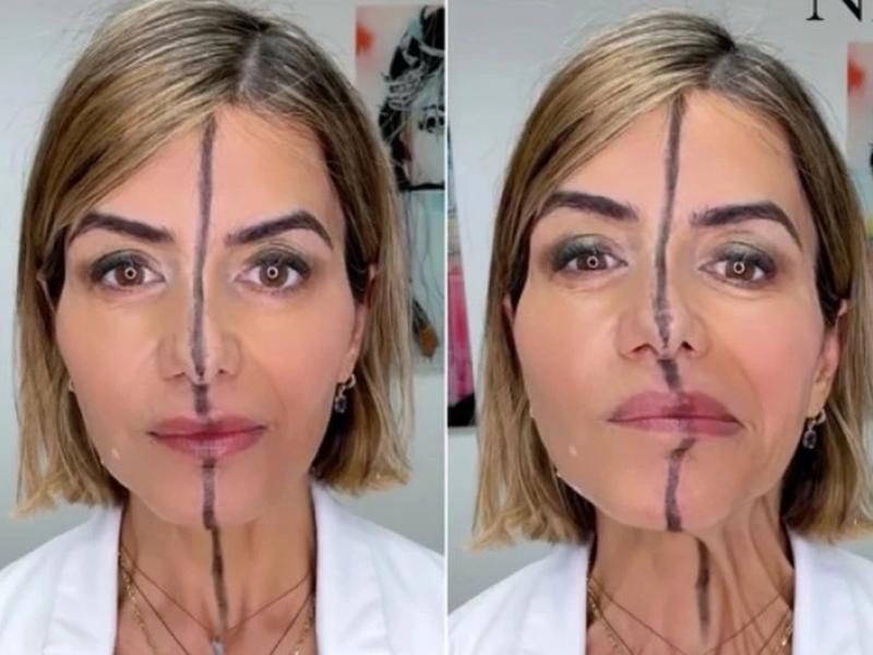Πείραμα με Botox: Γιατρός έκανε ένεση στο μισό πρόσωπό της και κατέγραψε τα εντυπωσιακά αποτελέσματα