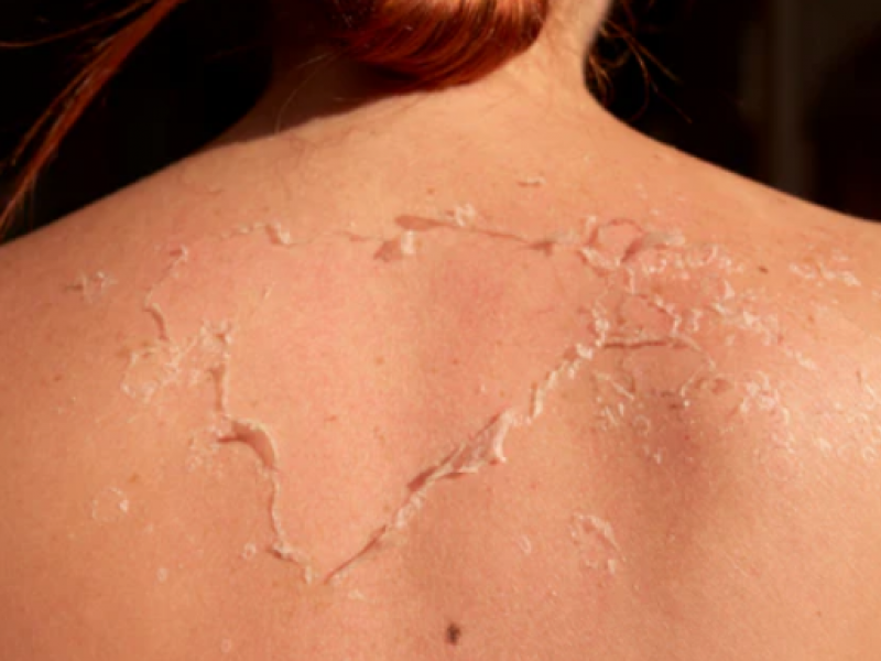 derma