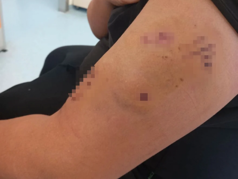 Πέραμα: Σκύλος επιτέθηκε σε 12χρονο έξω από σχολείο – «Ζητώ την τιμωρία του ιδιοκτήτη»