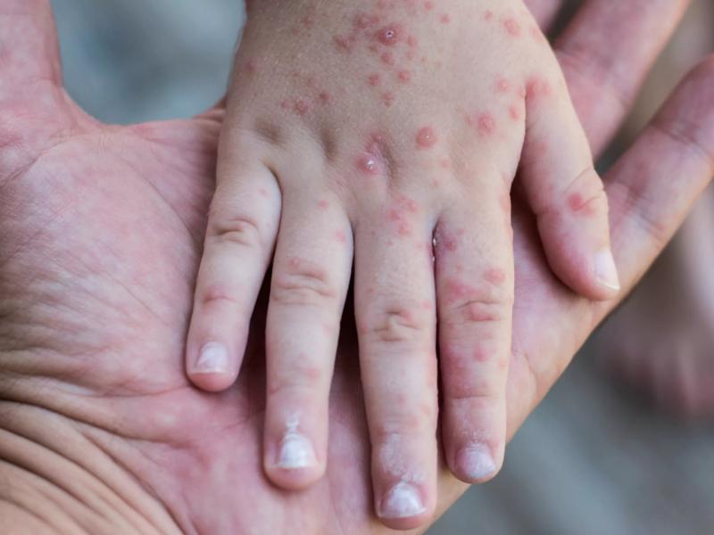 Συναγερμός για τον ιό κοξάκι: Αυξημένα κρούσματα σε παιδιά και έντονη ανησυχία σε γονείς