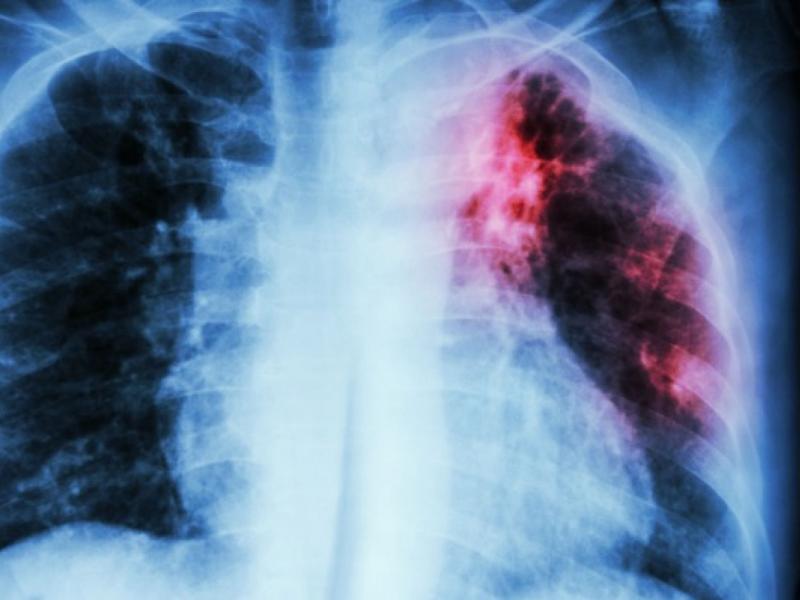 Πνευμονολόγος προειδοποιεί: Η φυματίωση δεν είχε εξαλειφθεί ποτέ στην Ελλάδα