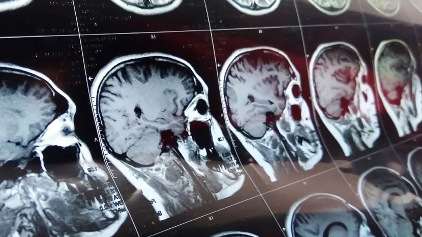 Neurological and neuropsychiatric complications of COVID-19 in 153 patients