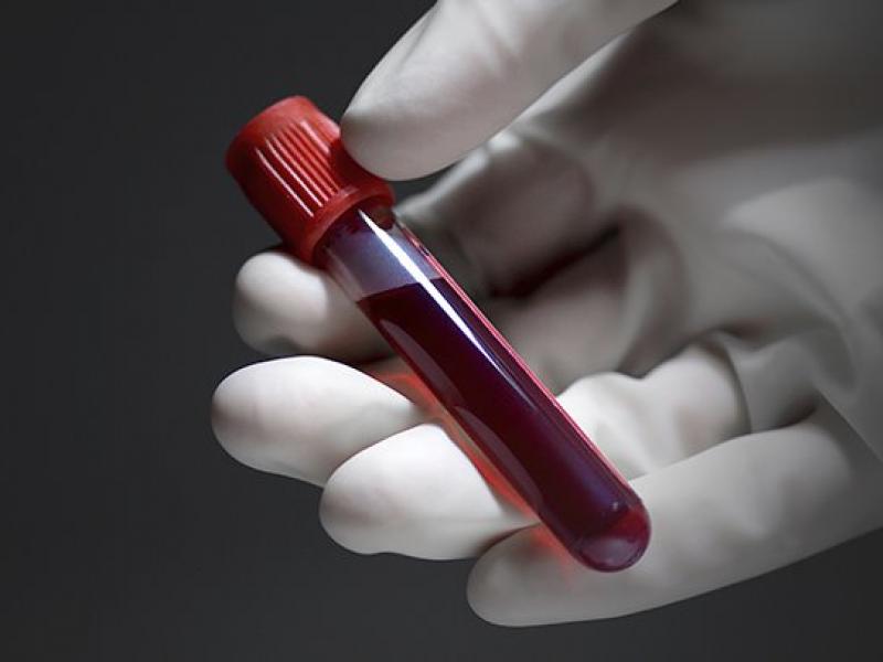 ΗΠΑ: Νέο «έξυπνο» τεστ αίματος ανιχνεύει τον καρκίνο του ήπατος