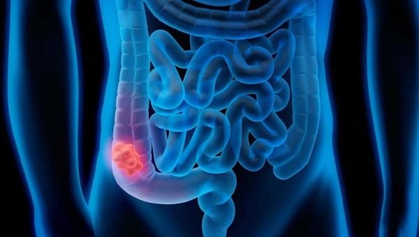 Καρκίνος Παχέος Εντέρου