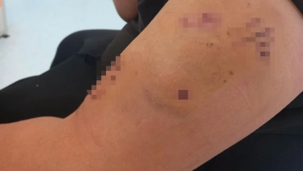 Τραύματα στο χέρι παιδιού από επίθεση σκύλου