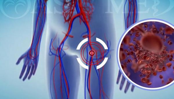 thromvosi