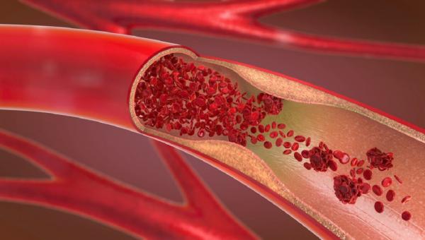 thromvosi.jpg