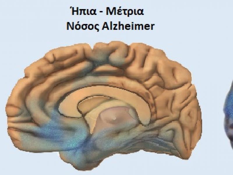 Αλτσχαιμερ-σταδια-νοσου.jpg