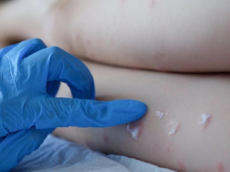 Ευλογιά των πιθήκων