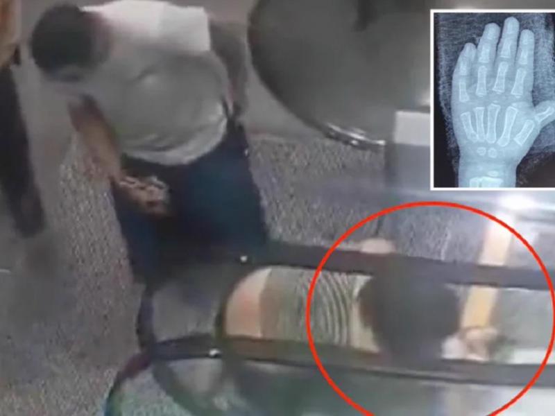 Παιδί δύο ετών εγκλώβισε το χέρι του σε κυλιόμενη σκάλα