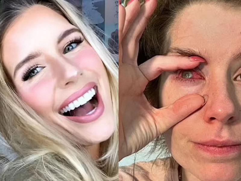 Μόλυνση από φακούς