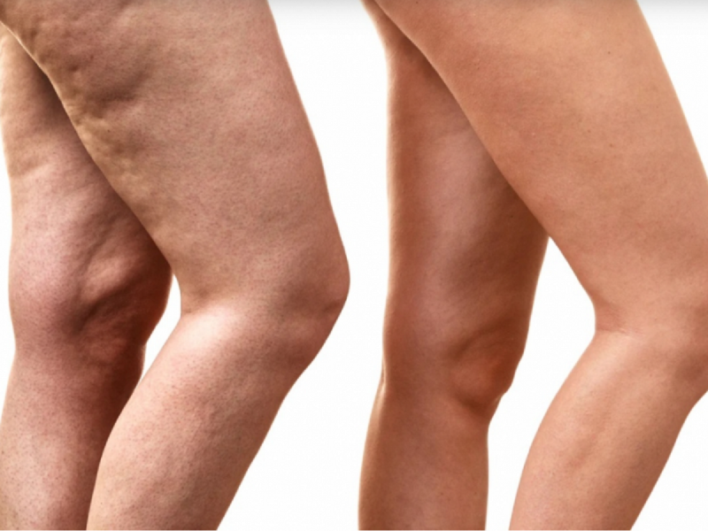 κυτταρίτιδα