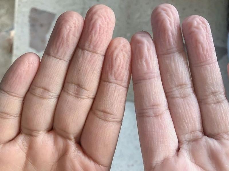 ζαρωμένα δάχτυλα