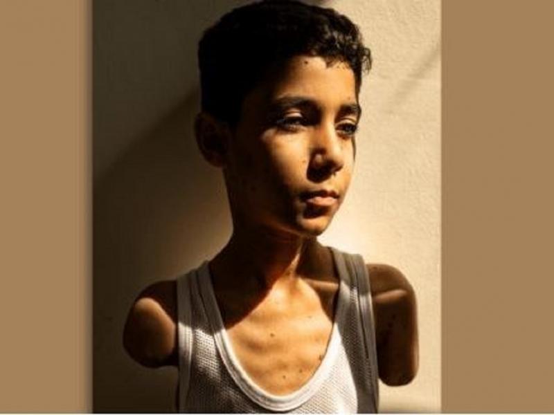 Φωτογραφία της χρονιάς o Παλαιστίνιος που έχασε και τα δύο του χέρια στη Γάζα