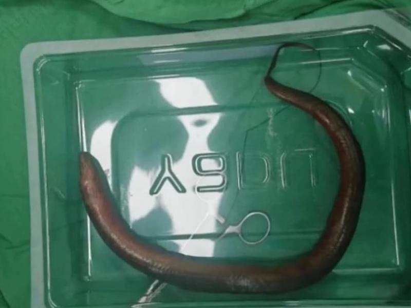 Αφαίρεση χελιού σε νοσοκομεία με επέμβαση