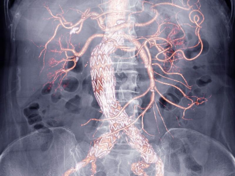 Ανεύρυσμα αορτής