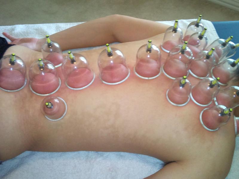 cupping03.jpg