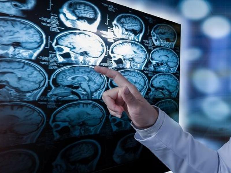 Σκλήρυνση κατά πλάκας