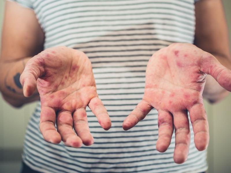 Σαμόα ιλαρά