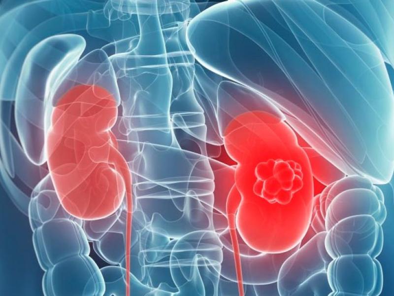 kidneys_cancer_image.jpg