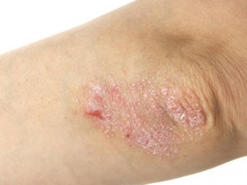 psoriasis-basics-optim.jpg