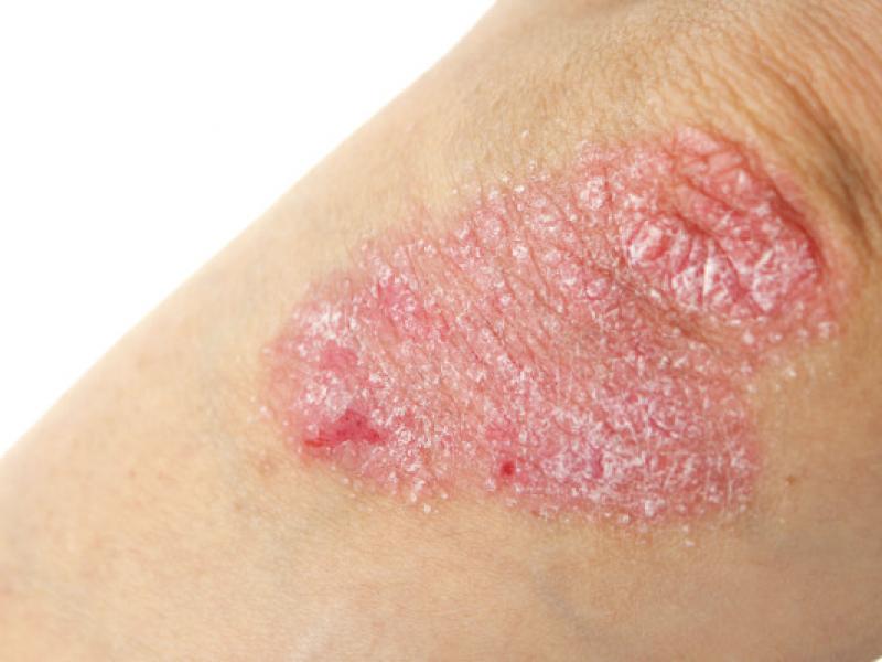 psoriasis3-666x399.jpg