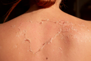 derma