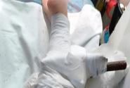 Ομπρέλα θαλάσσης καρφώθηκε στο πόδι μιας 26χρονης γυναίκας