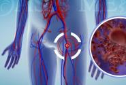 thromvosi