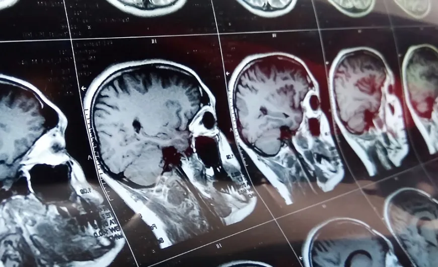 Neurological and neuropsychiatric complications of COVID-19 in 153 patients