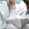 Ομπρέλα θαλάσσης καρφώθηκε στο πόδι μιας 26χρονης γυναίκας