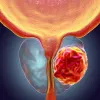 prostate