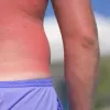 Κάψιμο από τον ήλιο