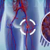 thromvosi