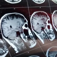 Neurological and neuropsychiatric complications of COVID-19 in 153 patients