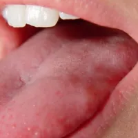 glossa