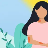 psoriasis