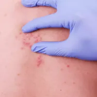 erpis_zostiras
